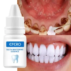 Blanqueamiento dentalSuero blanqueador dental - gel - higiene bucal - pasta de dientes